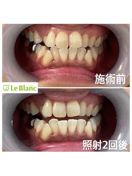 ルブラン 奈良店(Le Blanc)/大人気のコース!26回保証!