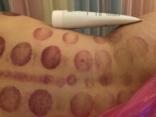 中国整体 らくらく堂/遠赤外線吸い玉+カッサ