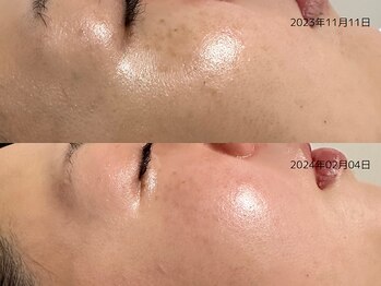 レイル(REIR)/メニュー:純粋レチノールピール