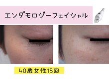 ビューティースパ/眼精疲労◎目元のシワケア♪