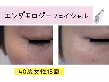 ビューティースパ/眼精疲労◎目元のシワケア♪