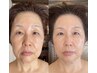《業界初》【（Lit）ヒト羊膜臍帯幹細胞】年齢逆転ほうれい線タルミ改善90分