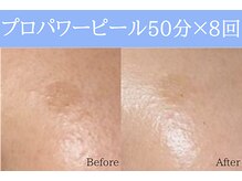 空 荻窪(くう)/プロパワーピール6回×2クール目