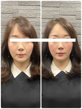 長寿鍼灸院 長寿整骨院/美容鍼50本の効果★小顔効果