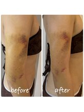 ルーシーガーデン(LUCY GARDEN)/ダウンタイムケア　インディバ