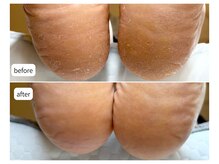 カシェット(Cachette)/60代女性◎足裏角質ケア90分