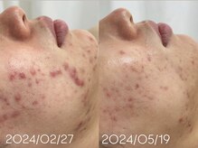 アンリミット 下北沢店(Une limit)/【ハーブの力でデトックス】