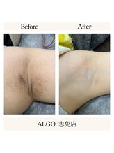 アルゴ 志免店(ALGO)/ワキもワックス！！