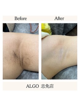 アルゴ 志免店(ALGO)/ワキもワックス！！
