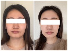 小顔矯正サロン ブルーム/フェイスラインがスッキリ