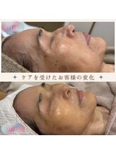 美肌研究所 絹 田辺店/法令線・目じりのシワ・たるみ