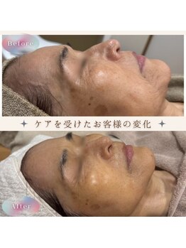 美肌研究所 絹 田辺店/法令線・目じりのシワ・たるみ