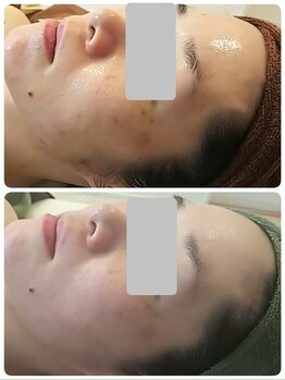 デイスパ コオリナ(DAYSPA Ko olina)/シミケア◎毛穴レス◎