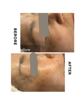 キレナル(KIRENAL)/ラミネーションピール