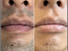 エリクサー 加須店(Elixir)/大人気ヒゲ脱毛！