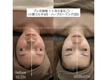 サロンワイアネシス(Salon y ANESIS)/小顔コルギ×ハーブピーリング