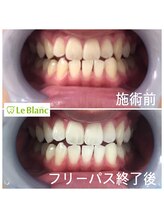 ルブラン 奈良店(Le Blanc)/週一ペースで白く！！