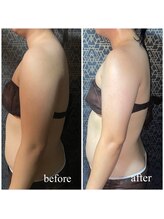 ラクラク(rakuraku)/上半身痩身（二の腕）