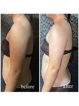 ラクラク(rakuraku)/上半身痩身(二の腕)