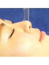 セレブヒルズ 札幌本店(Celeb Hill's)/毛穴吸引