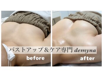 デミーナ(Demyna)/【バストアップ】症例 育乳