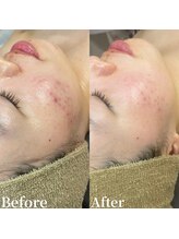 アンバー(amber)/ニキビケア ハーブピーリング