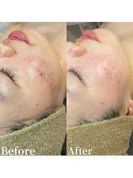 アンバー(amber)/ニキビケア ハーブピーリング