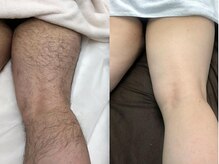 シャイン(SHINE)の雰囲気（メンズの剛毛、レディースの産毛に対応◎効果抜群の脱毛体験を）