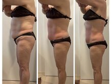 ヴィクシア(VIXIA)/痩身90分