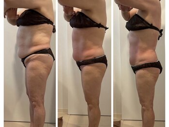 ヴィクシア(VIXIA)/痩身90分