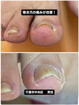 千葉市中央区で巻き爪の痛み改善