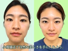 ナチュラルパーフェクトフェイス 新宿/小顔矯正/新宿/渋谷区/造顔小顔