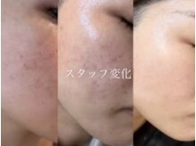 オーシャンブルーム 目黒(OceanBloom)/敏感肌／バリア機能の低下