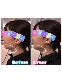 小顔になりたい