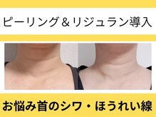 豊能町／シワ／たるみ／ハーブピーリング