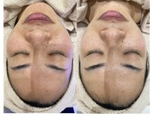 ウェイビーズ エステ(wavy's.esthetic)/ビフォーアフター】毛穴ケア