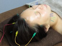 はりめぐり/電気鍼