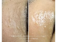 ストーリー(STORY)/ハーブピーリング専門店STORY