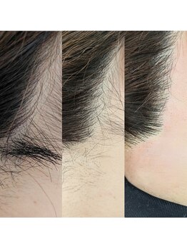 スターリー(Starry)/部分WAX脱毛