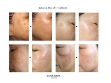 セレーノ 白金台(seReno)/シミ改善症例