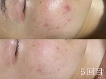 ホワイトアクア 中目黒店(WHITE AQUA)/ララピール/美白/中目黒