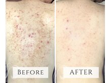 マヴィ(mavie)/ハーブピーリング（ボディ）