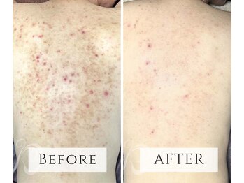 マヴィ(mavie)/ハーブピーリング（ボディ）