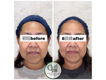 キュープ 相模原淵野辺店(Qpu)/たった4回で人生で1番小さな顔に