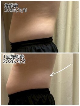 クールスパ(COOL SPA)/【20代男性】お腹症例