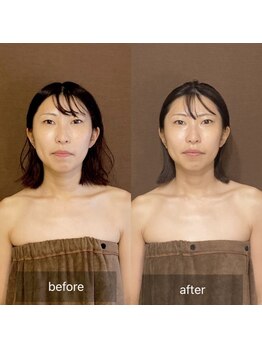 ラペ(La paix)/脳洗浄before/after