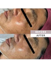 とぅるりん 肌質改善/シンエイク深いシワにアプローチ