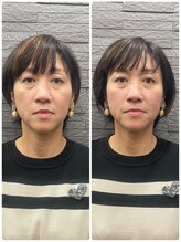 長寿鍼灸院 長寿整骨院/美容鍼25本の効果★リフトアップ