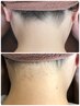 ★男性限定・選べる【全身美肌脱毛+お顔またはVIO】¥24000→¥18000！初回限定