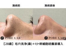 メンズアメリ/高知/メンズ/ヒゲ/毛穴洗浄/頭皮